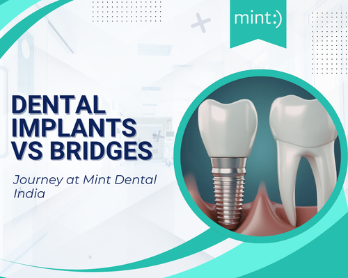 Dental Implants vs Bridges: Best Long-Term Tooth Replacement Solution