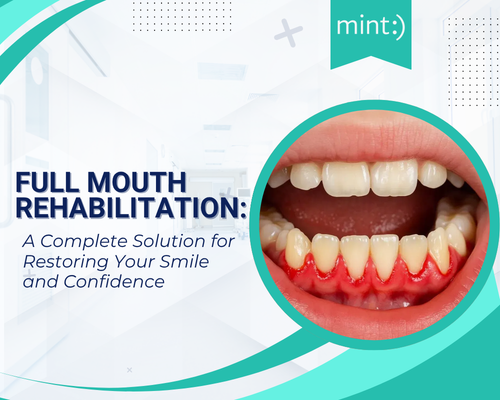 Full Mouth Rehabilitation: A Complete Solution for Restoring Your Smile and Confidence